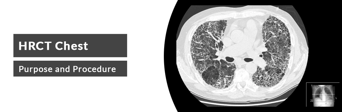 HRCT Chest: Purpose and Procedure